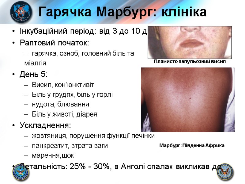 Гарячка Марбург: клініка Інкубаційний період: від 3 до 10 днів Раптовий початок:  гарячка,